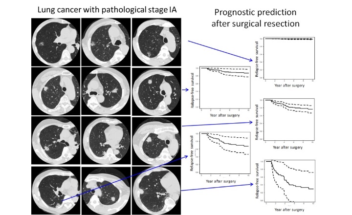 肺がんの悪性度を測る「肺がんのCT画像・病理・遺伝子による高度悪性度・予後予測」